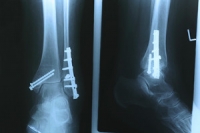 Fractured Ankle Pain