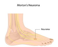 Nerve Growth and Morton’s Neuroma