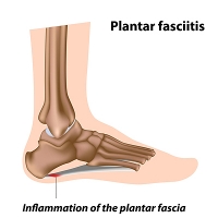 Morning Foot Pain May Indicate Plantar Fasciitis